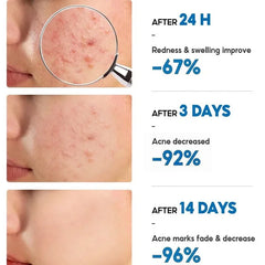 Salicylic Acid Acne Cream – Anti-Acne, Pimple & Redness Repair
