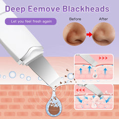 Ultrasonic Skin Scrubber – Electric Face Spatula for Deep Cleansing & Blackhead Removal
