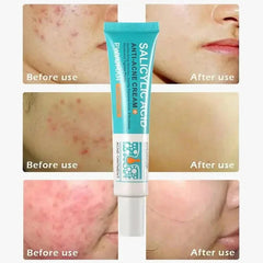 Salicylic Acid Acne Cream – Anti-Acne, Pimple & Redness Repair