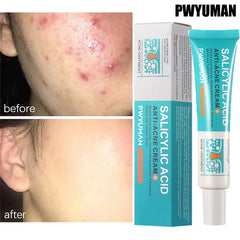 Salicylic Acid Acne Cream – Anti-Acne, Pimple & Redness Repair