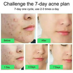 Salicylic Acid Acne Cream – Anti-Acne, Pimple & Redness Repair
