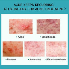 Salicylic Acid Acne Cream – Anti-Acne, Pimple & Redness Repair